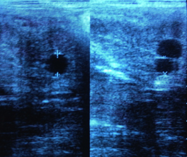 Ultrasound endometrial cysts in the mare